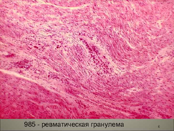 985 - ревматическая гранулема 6 