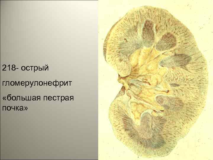 218 - острый гломерулонефрит «большая пестрая почка» 11 