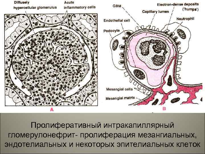 Пролиферативный интракапиллярный гломерулонефрит- пролиферация мезангиальных, эндотелиальных и некоторых эпителиальных клеток 12 
