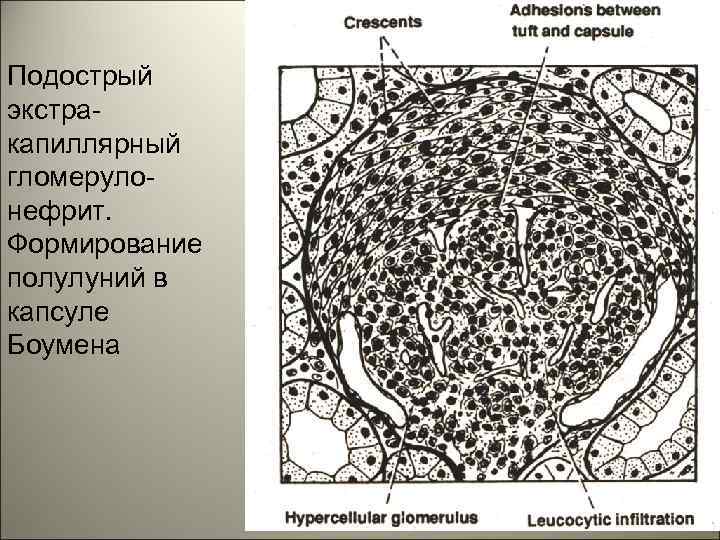 Подострый экстракапиллярный гломерулонефрит. Формирование полулуний в капсуле Боумена 15 
