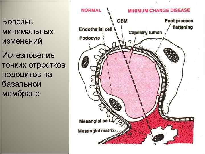 Болезнь минимальных изменений Исчезновение тонких отростков подоцитов на базальной мембране 19 
