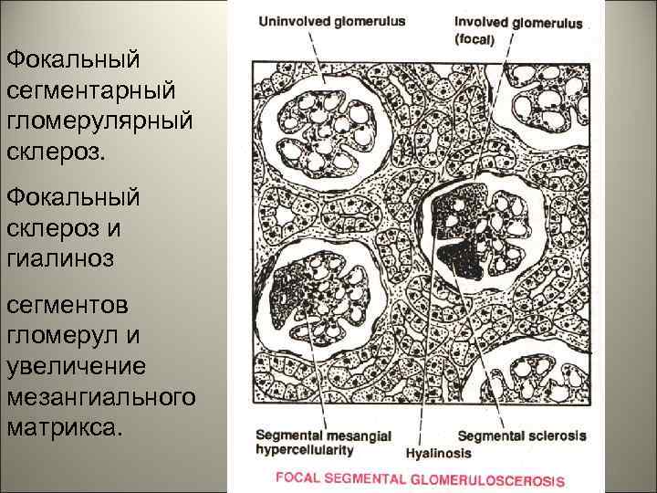 Фокальный сегментарный гломерулярный склероз. Фокальный склероз и гиалиноз сегментов гломерул и увеличение мезангиального матрикса.