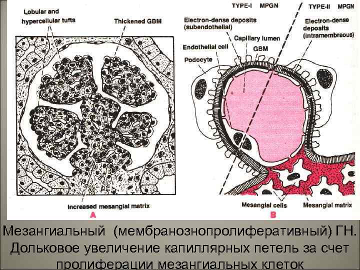 Мезангиальный (мембранознопролиферативный) ГН. Дольковое увеличение капиллярных петель за счет 23 пролиферации мезангиальных клеток 