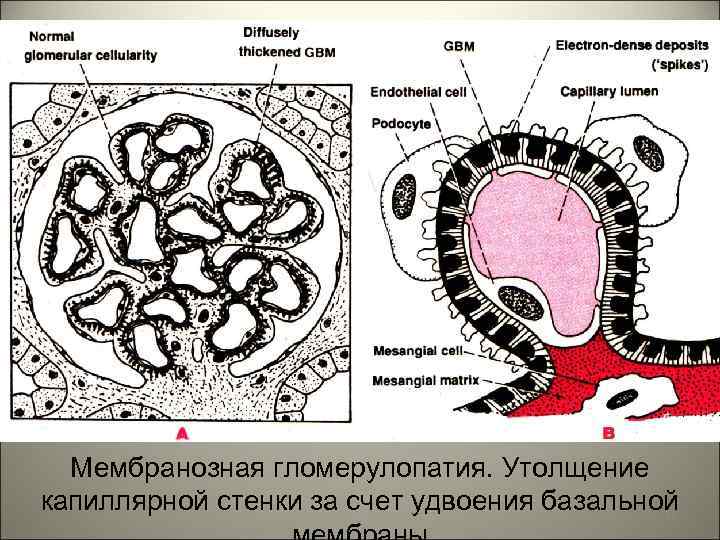 Мембранозная гломерулопатия. Утолщение капиллярной стенки за счет удвоения базальной 25 