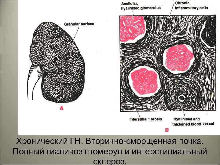 Хронический ГН. Вторично-сморщенная почка. Полный гиалиноз гломерул и интерстициальный 27 склероз. 