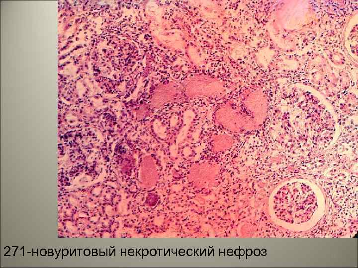 271 -новуритовый некротический нефроз 33 