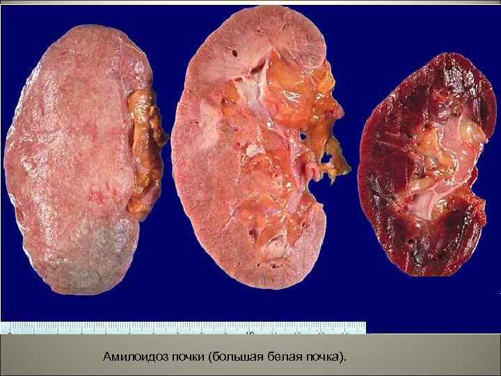 Амилоидоз почки (большая белая почка). 41 