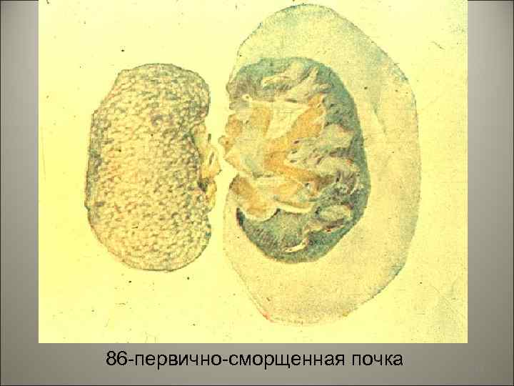 86 -первично-сморщенная почка 44 