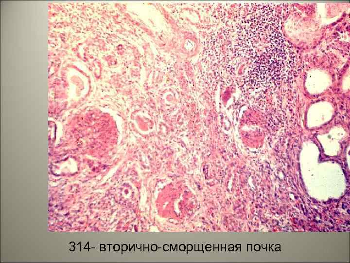 314 - вторично-сморщенная почка 46 