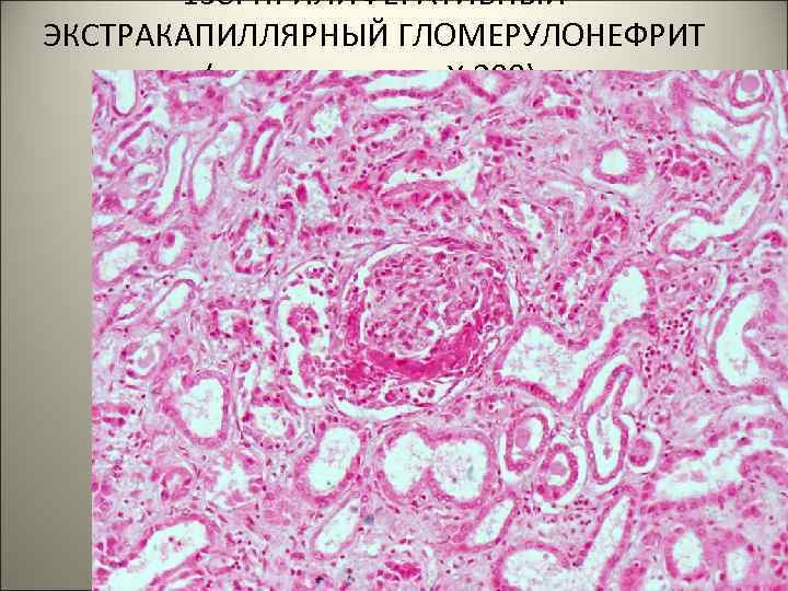 138. ПРИЛИФЕРАТИВНЫЙ ЭКСТРАКАПИЛЛЯРНЫЙ ГЛОМЕРУЛОНЕФРИТ (демонстрация, Х 200). . 