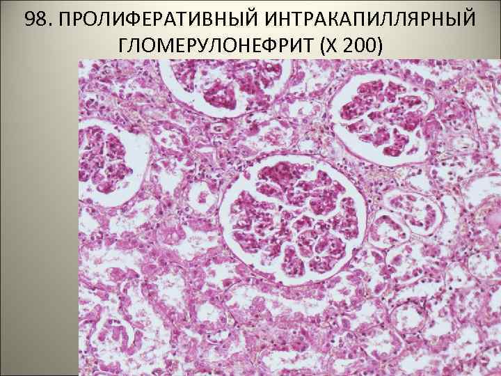 98. ПРОЛИФЕРАТИВНЫЙ ИНТРАКАПИЛЛЯРНЫЙ ГЛОМЕРУЛОНЕФРИТ (Х 200) 