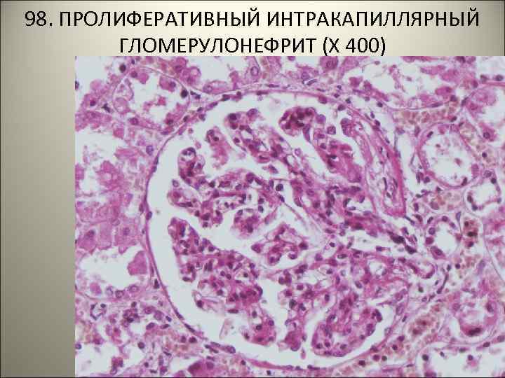 98. ПРОЛИФЕРАТИВНЫЙ ИНТРАКАПИЛЛЯРНЫЙ ГЛОМЕРУЛОНЕФРИТ (Х 400) 