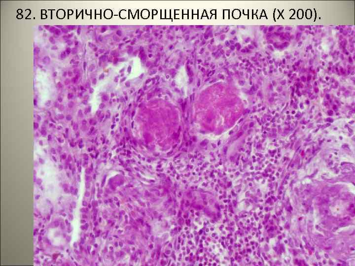 82. ВТОРИЧНО-СМОРЩЕННАЯ ПОЧКА (Х 200). 