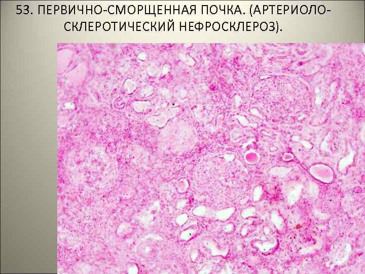 53. ПЕРВИЧНО-СМОРЩЕННАЯ ПОЧКА. (АРТЕРИОЛОСКЛЕРОТИЧЕСКИЙ НЕФРОСКЛЕРОЗ). 