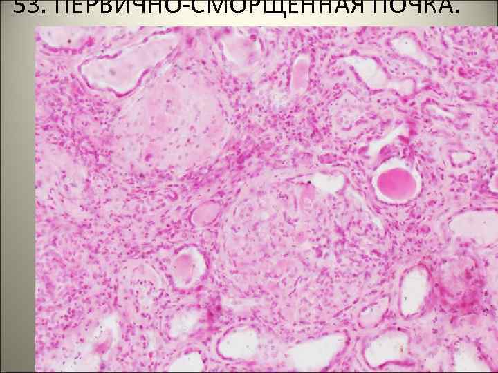 53. ПЕРВИЧНО-СМОРЩЕННАЯ ПОЧКА. 