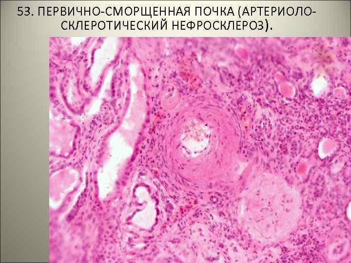 53. ПЕРВИЧНО-СМОРЩЕННАЯ ПОЧКА (АРТЕРИОЛОСКЛЕРОТИЧЕСКИЙ НЕФРОСКЛЕРОЗ). 
