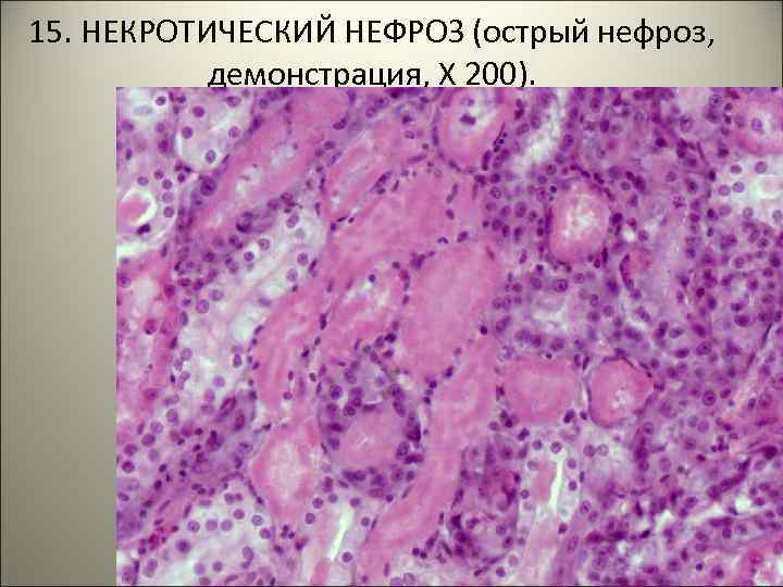 15. НЕКРОТИЧЕСКИЙ НЕФРОЗ (острый нефроз, демонстрация, Х 200). 