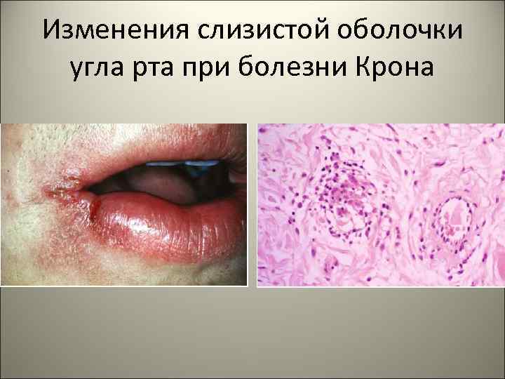 Изменения слизистой оболочки угла рта при болезни Крона 