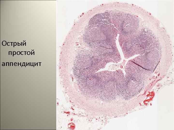 Острый простой аппендицит 70 