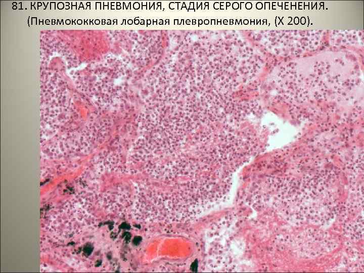 81. КРУПОЗНАЯ ПНЕВМОНИЯ, СТАДИЯ СЕРОГО ОПЕЧЕНЕНИЯ. (Пневмококковая лобарная плевропневмония, (Х 200). . . 