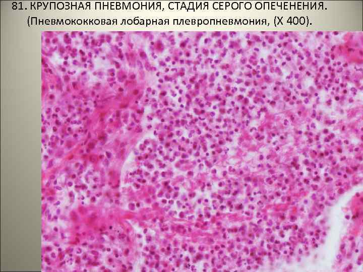 81. КРУПОЗНАЯ ПНЕВМОНИЯ, СТАДИЯ СЕРОГО ОПЕЧЕНЕНИЯ. (Пневмококковая лобарная плевропневмония, (Х 400). . . 
