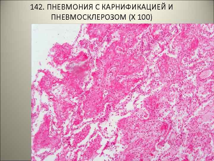 142. ПНЕВМОНИЯ С КАРНИФИКАЦИЕЙ И ПНЕВМОСКЛЕРОЗОМ (Х 100) 