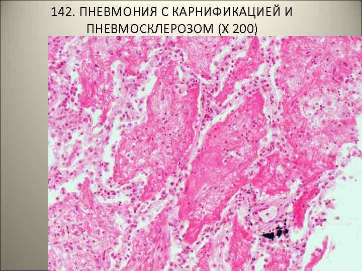 142. ПНЕВМОНИЯ С КАРНИФИКАЦИЕЙ И ПНЕВМОСКЛЕРОЗОМ (Х 200) 