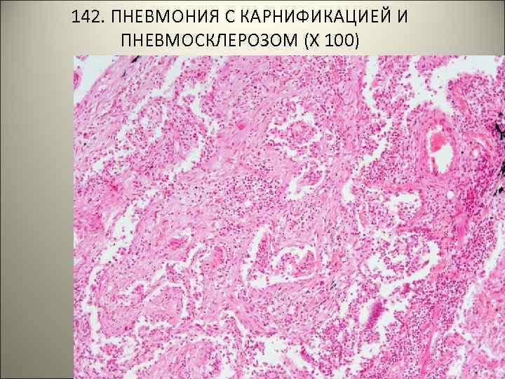 142. ПНЕВМОНИЯ С КАРНИФИКАЦИЕЙ И ПНЕВМОСКЛЕРОЗОМ (Х 100) 