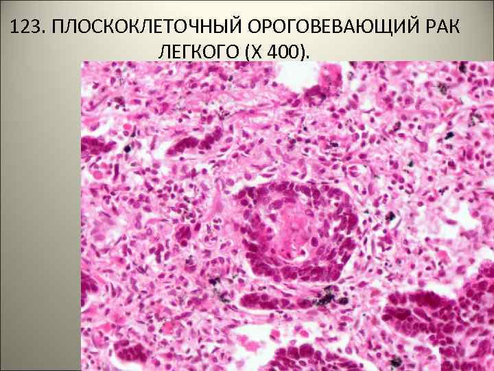 123. ПЛОСКОКЛЕТОЧНЫЙ ОРОГОВЕВАЮЩИЙ РАК ЛЕГКОГО (Х 400). 