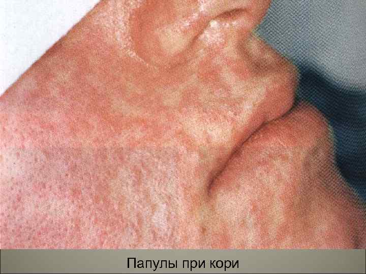 Папулы при кори 11 