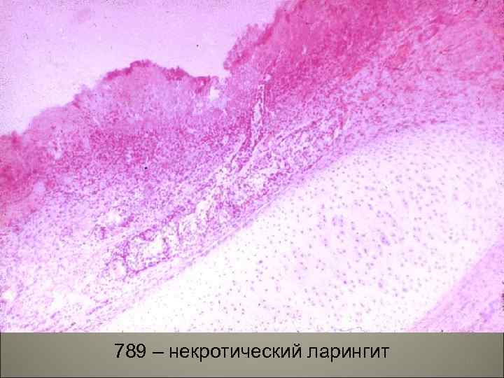 789 – некротический ларингит 25 