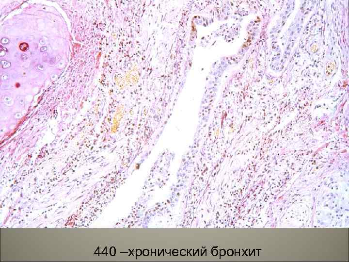 440 –хронический бронхит 29 