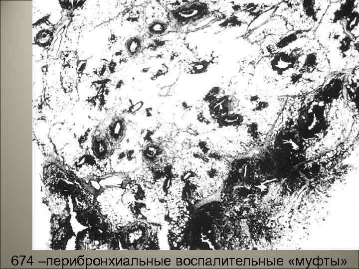 37 674 –перибронхиальные воспалительные «муфты» 