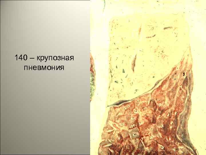 140 – крупозная пневмония 44 