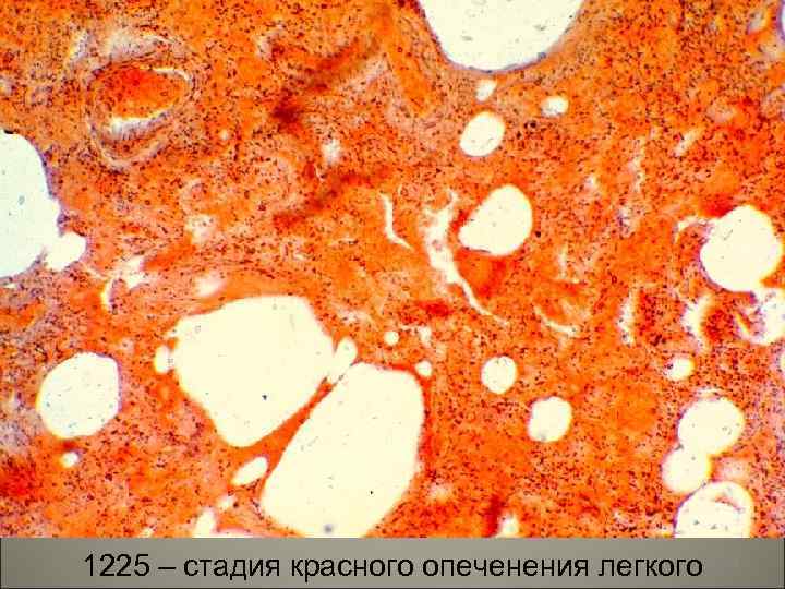 1225 – стадия красного опеченения легкого 50 