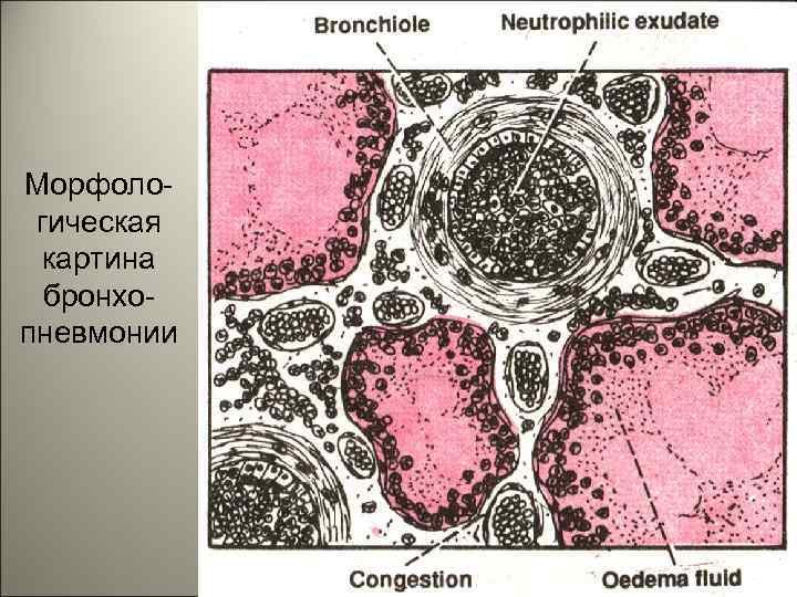 Морфологическая картина бронхопневмонии 69 