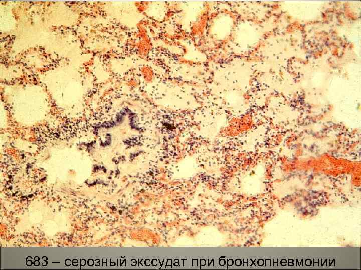 70 683 – серозный экссудат при бронхопневмонии 
