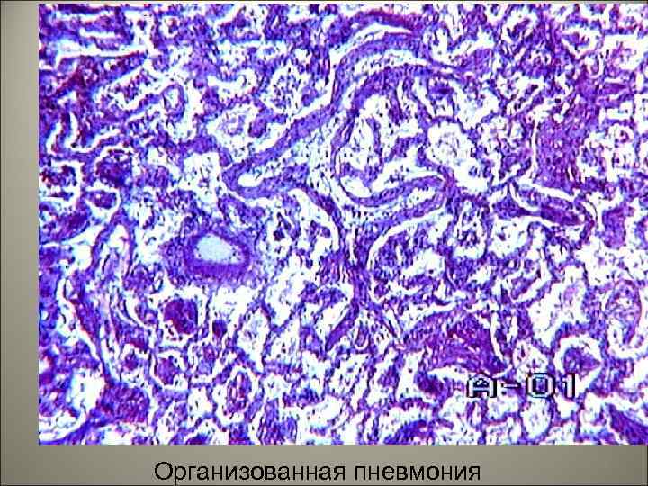 Организованная пневмония 79 
