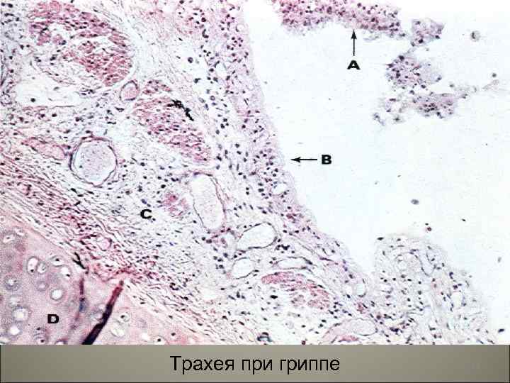 Трахея при гриппе 84 