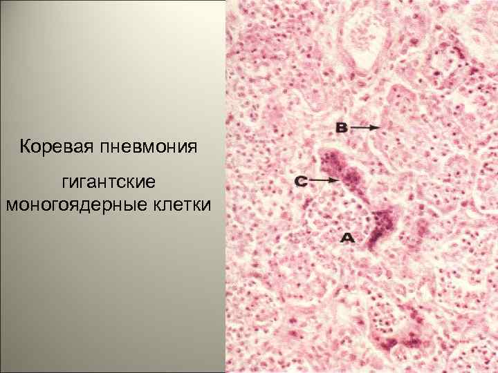 Коревая пневмония гигантские моногоядерные клетки 15 