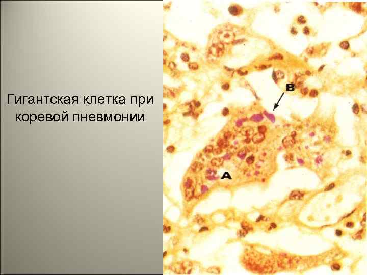 Гигантская клетка при коревой пневмонии 16 