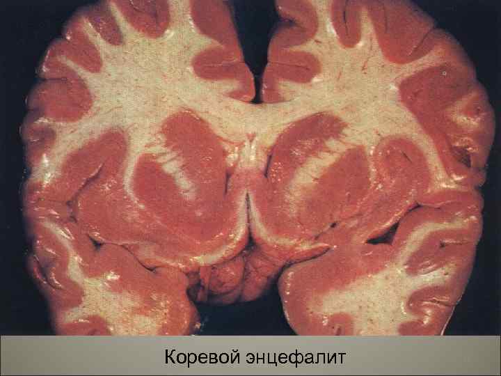 Коревой энцефалит 19 