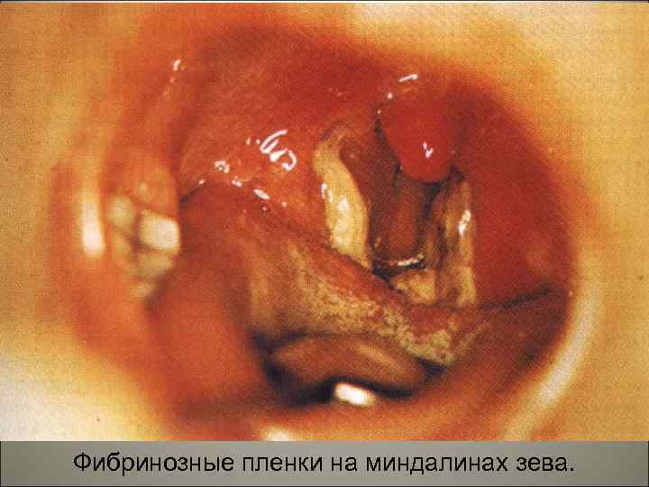 Фибринозные пленки на миндалинах зева. 27 