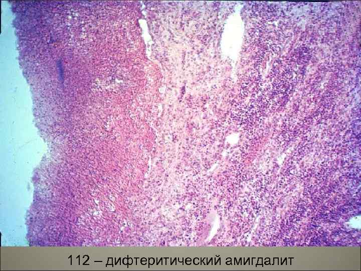 112 – дифтеритический амигдалит 30 