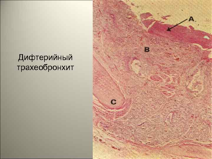Дифтерийный трахеобронхит 32 