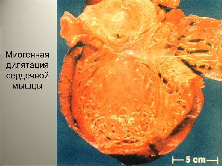 Миогенная дилятация сердечной мышцы 37 