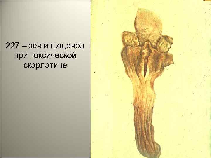 227 – зев и пищевод при токсической скарлатине 46 