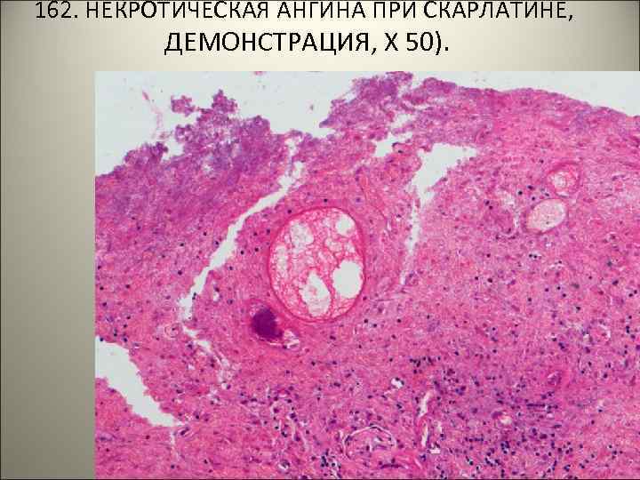 162. НЕКРОТИЧЕСКАЯ АНГИНА ПРИ СКАРЛАТИНЕ, ДЕМОНСТРАЦИЯ, Х 50). . 