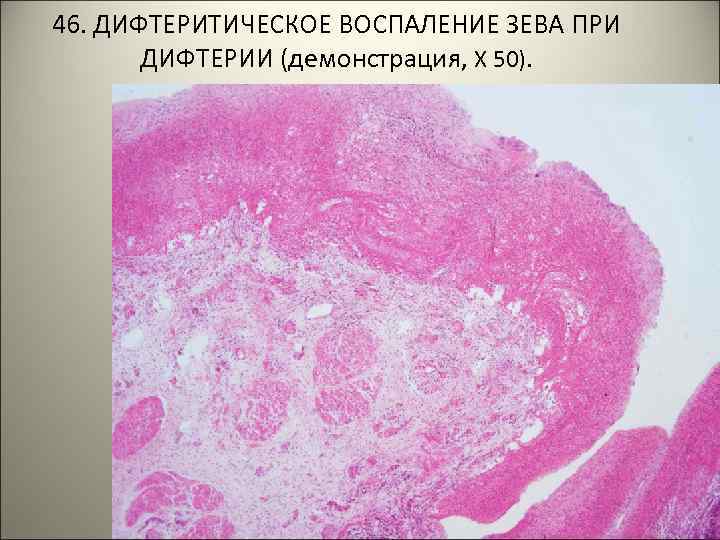 46. ДИФТЕРИТИЧЕСКОЕ ВОСПАЛЕНИЕ ЗЕВА ПРИ ДИФТЕРИИ (демонстрация, Х 50). . . 