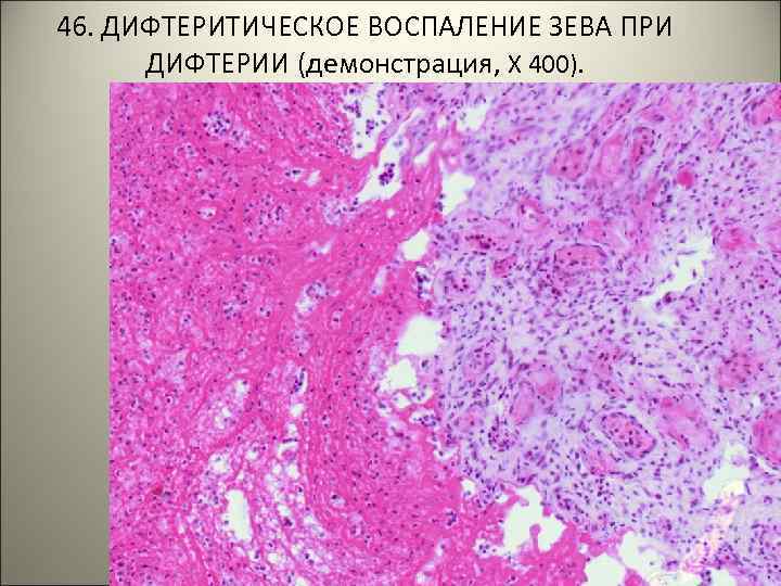 46. ДИФТЕРИТИЧЕСКОЕ ВОСПАЛЕНИЕ ЗЕВА ПРИ ДИФТЕРИИ (демонстрация, Х 400). . . 